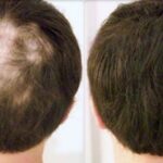 Trous dans les cheveux chez les hommes : comment arrivent-ils et comment y remédier ?